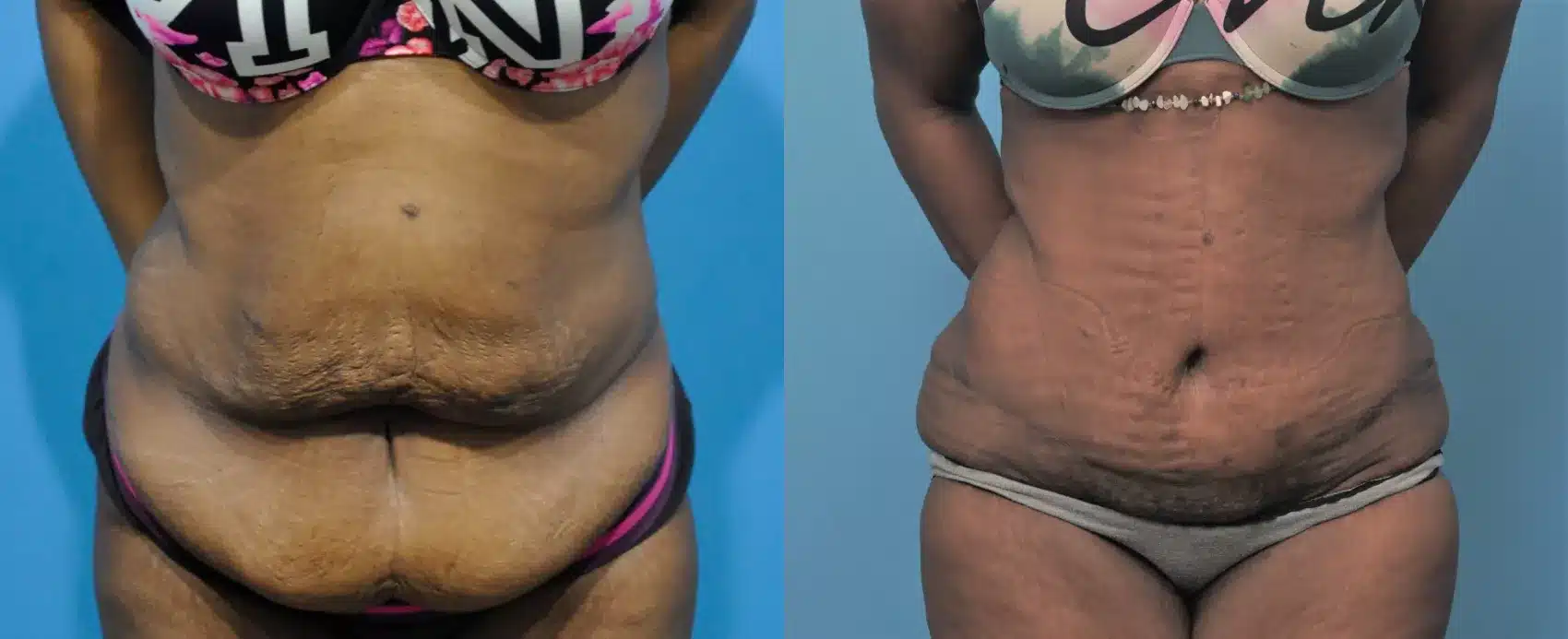 Before and After Image: Case #305 - front