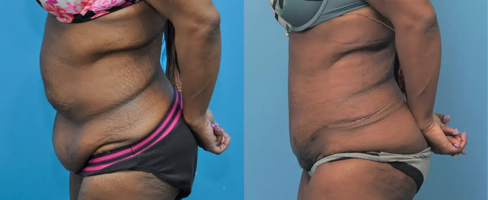 Before and After Image: Case #305 - left-side