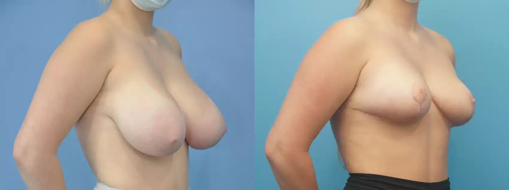 Before and After Image: Case #306 - right-front-oblique