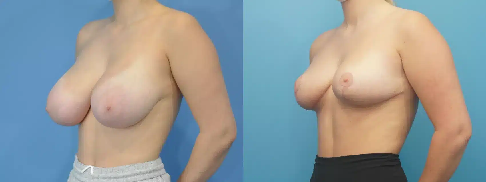 Before and After Image: Case #306 - left-front-oblique