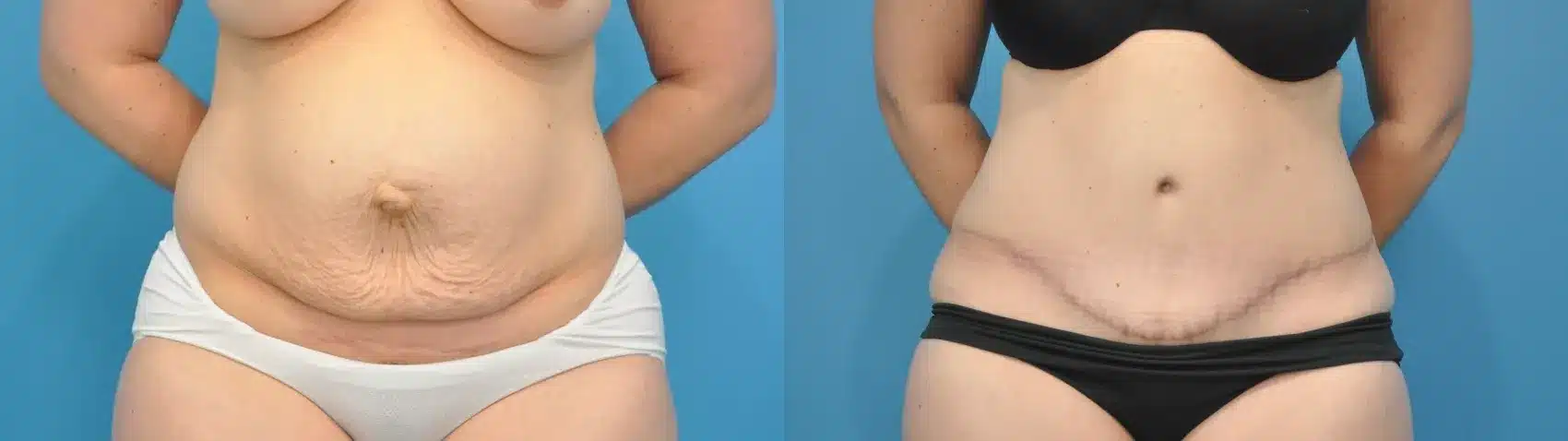 Before and After Image: Case #308 - front