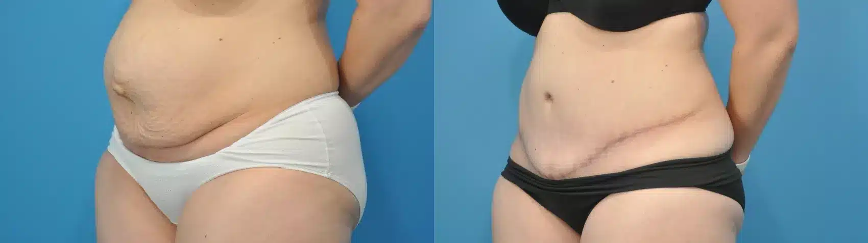 Before and After Image: Case #308 - left-front-oblique