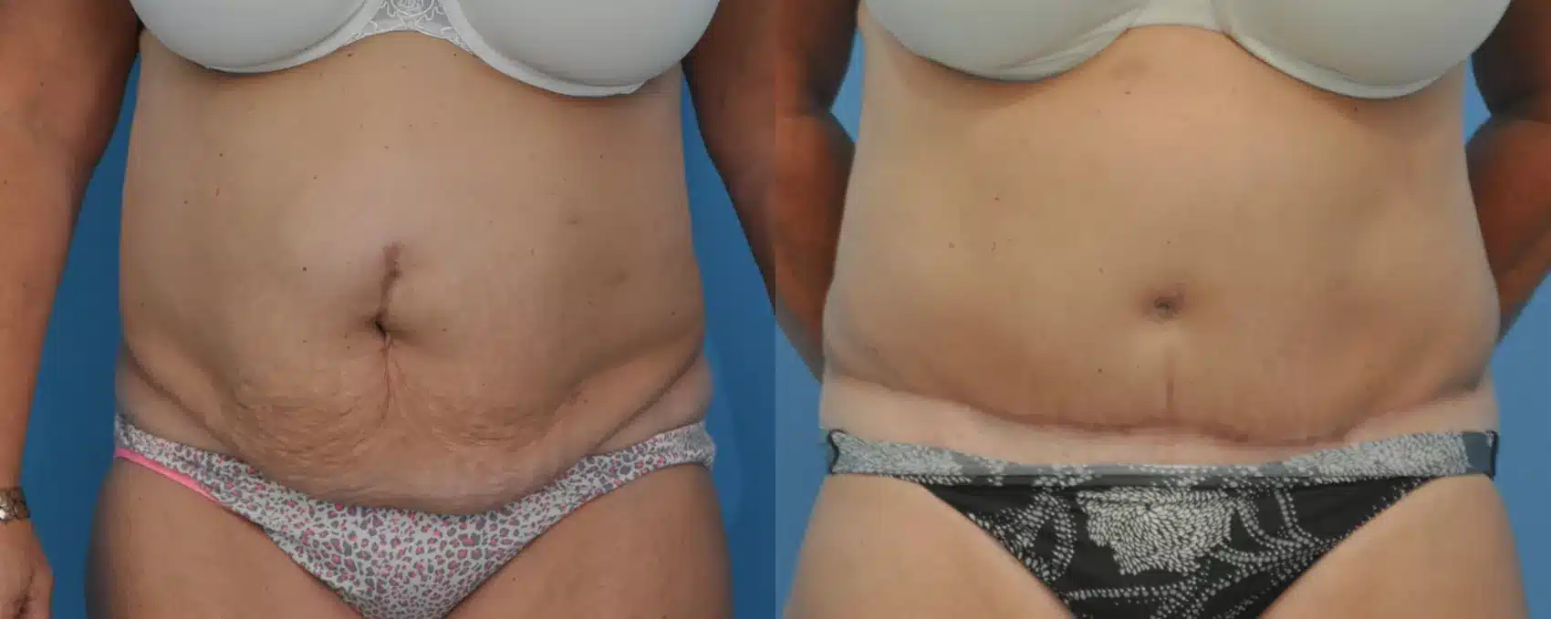 Before and After Image: Case #31 - front