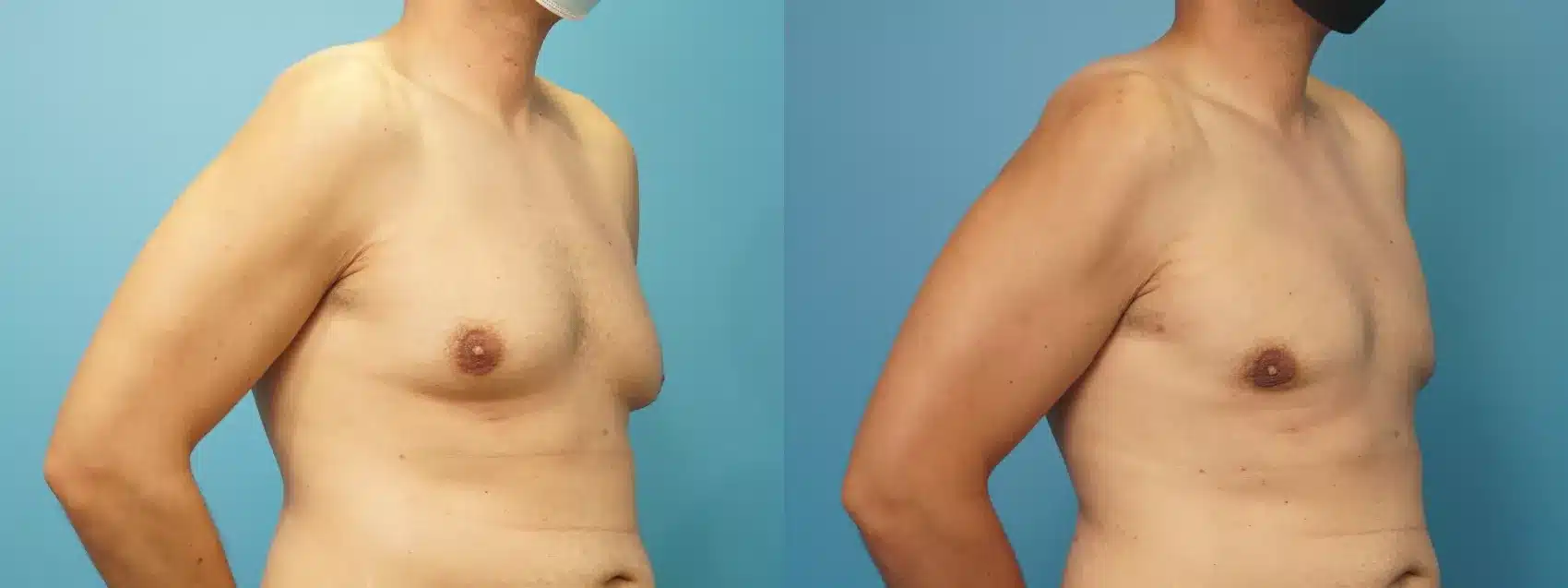 Before and After Image: Case #310 - right-front-oblique