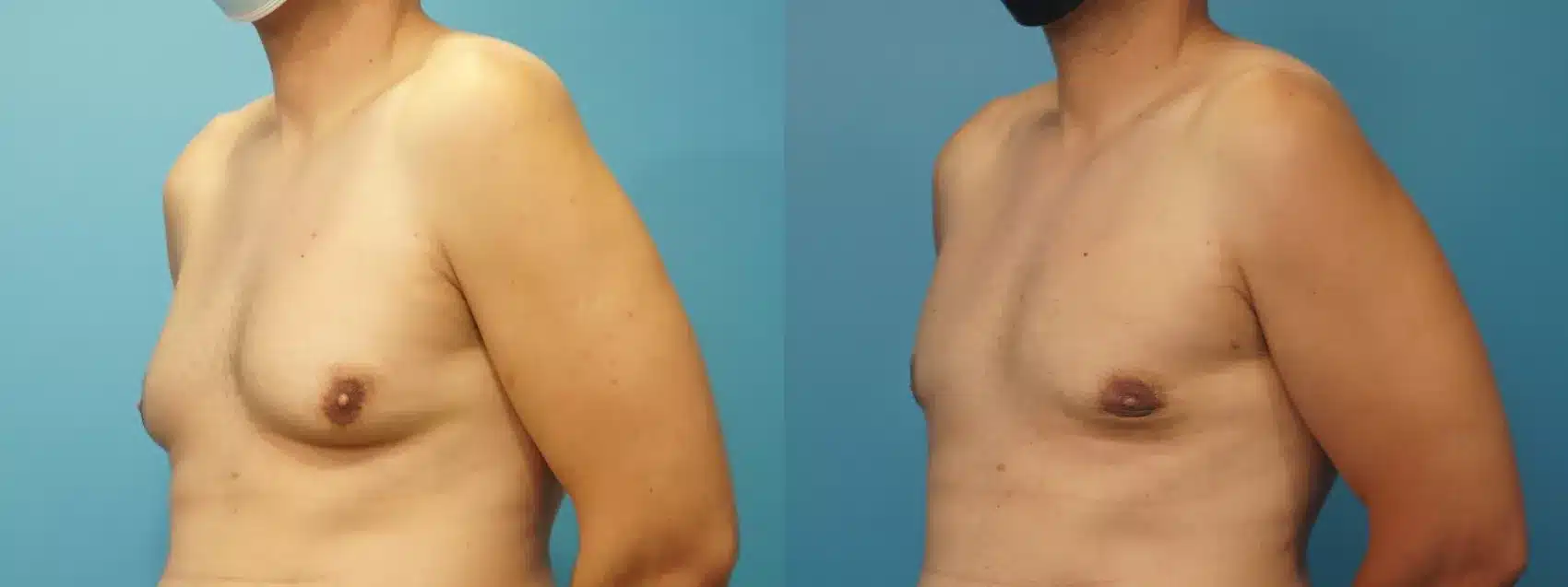 Before and After Image: Case #310 - left-front-oblique