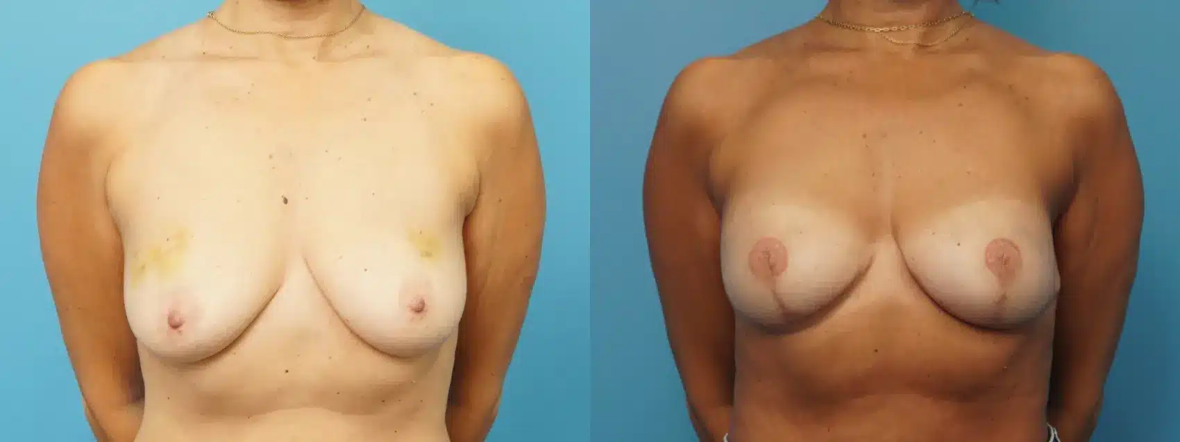 Before and After Image: Skin Sparing Mastectomy Reconstruction with Implants - front