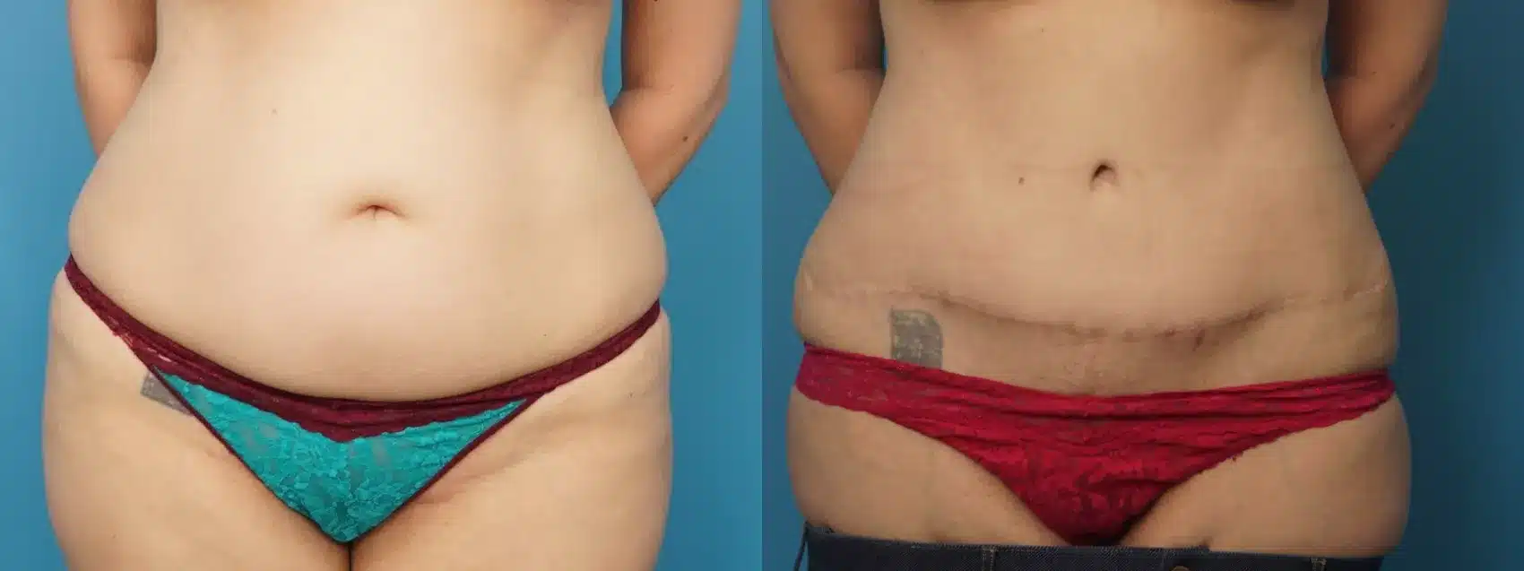 Before and After Image: Case #312 - front