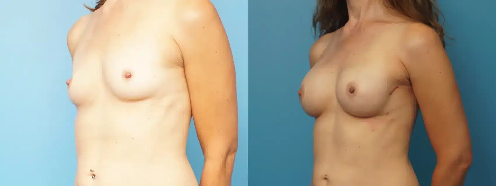 Before and After Image: Implant Reconstruction after Robotic Mastectomy - left-front-oblique