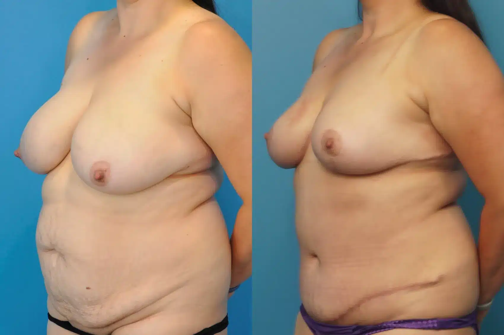 Before and After Image: Breast Lift and Tummy Tuck - left-front-oblique
