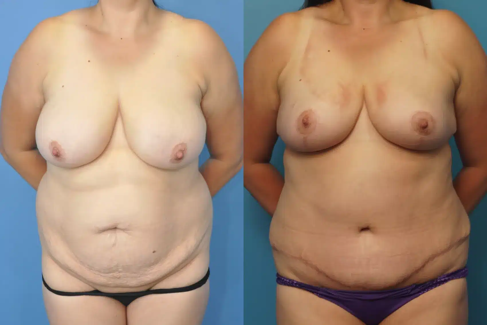 Before and After Image: Breast Lift and Tummy Tuck - front