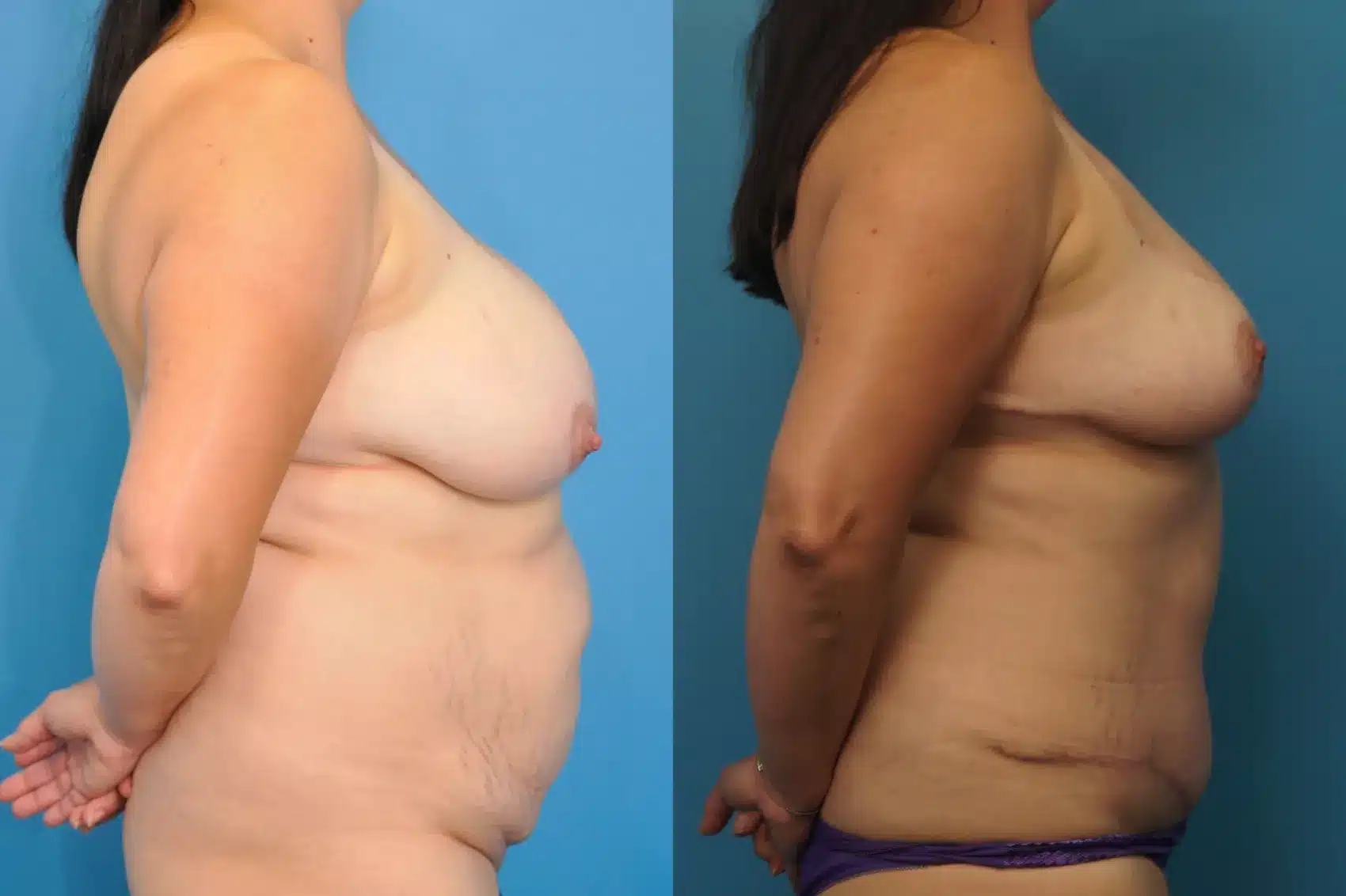 Before and After Image: Breast Lift and Tummy Tuck - right-side