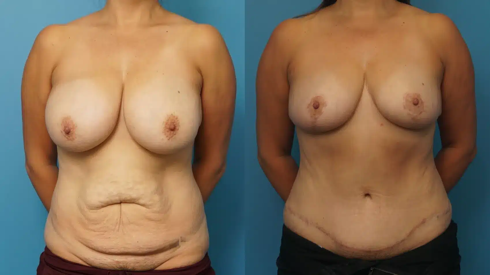 Before and After Image: Breast Reduction/Lift and Tummy Tuck - front