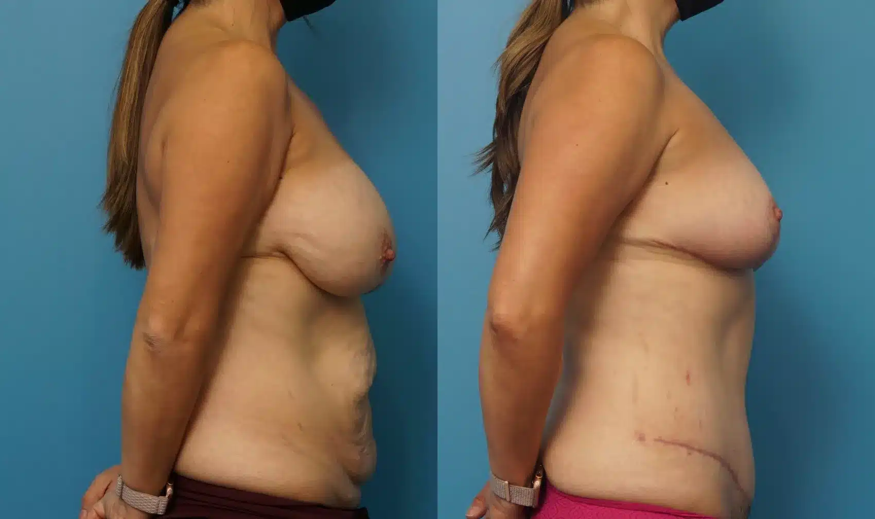 Before and After Image: Breast Reduction/Lift and Tummy Tuck - right-side