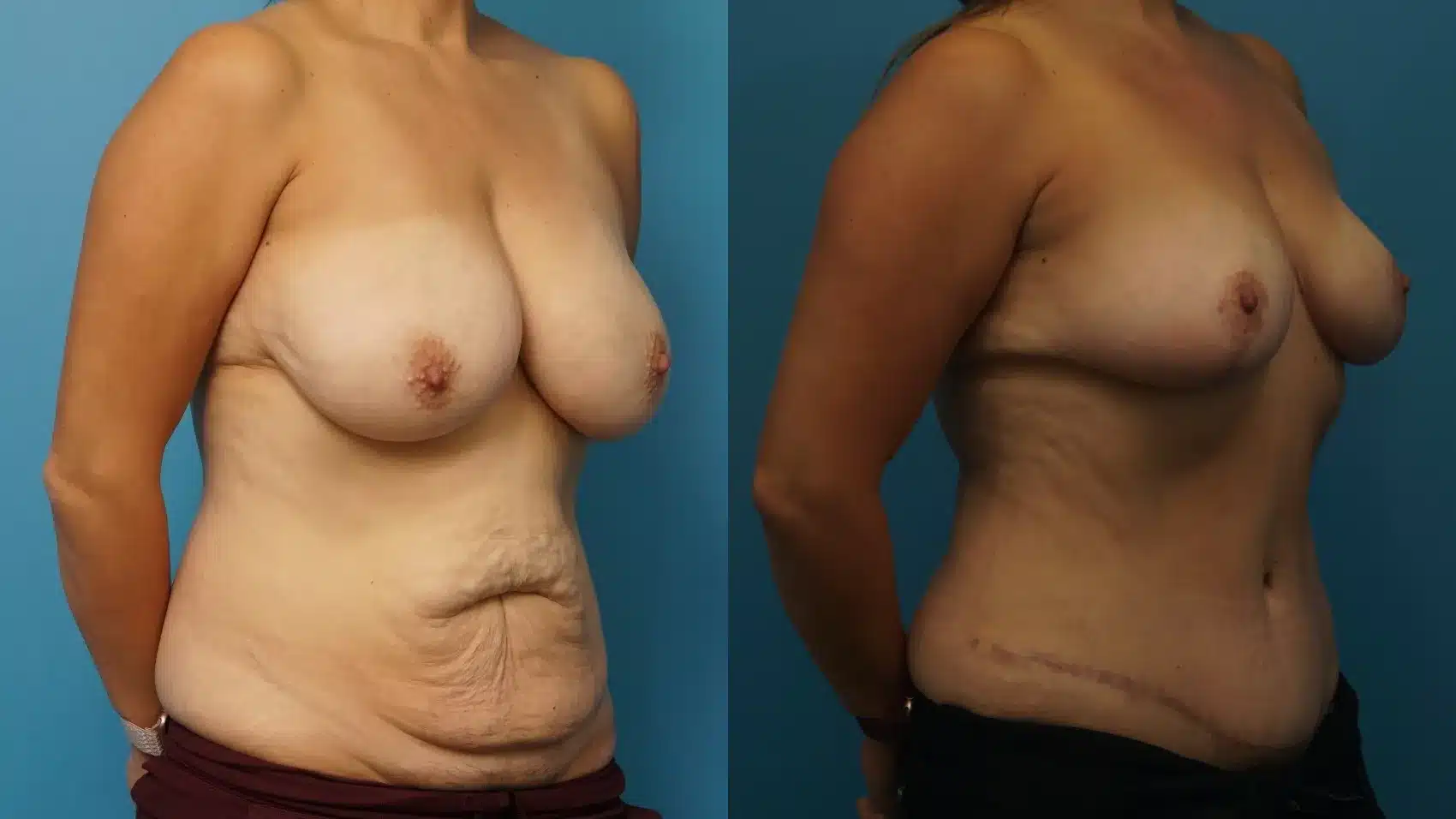 Before and After Image: Breast Reduction/Lift and Tummy Tuck - right-front-oblique