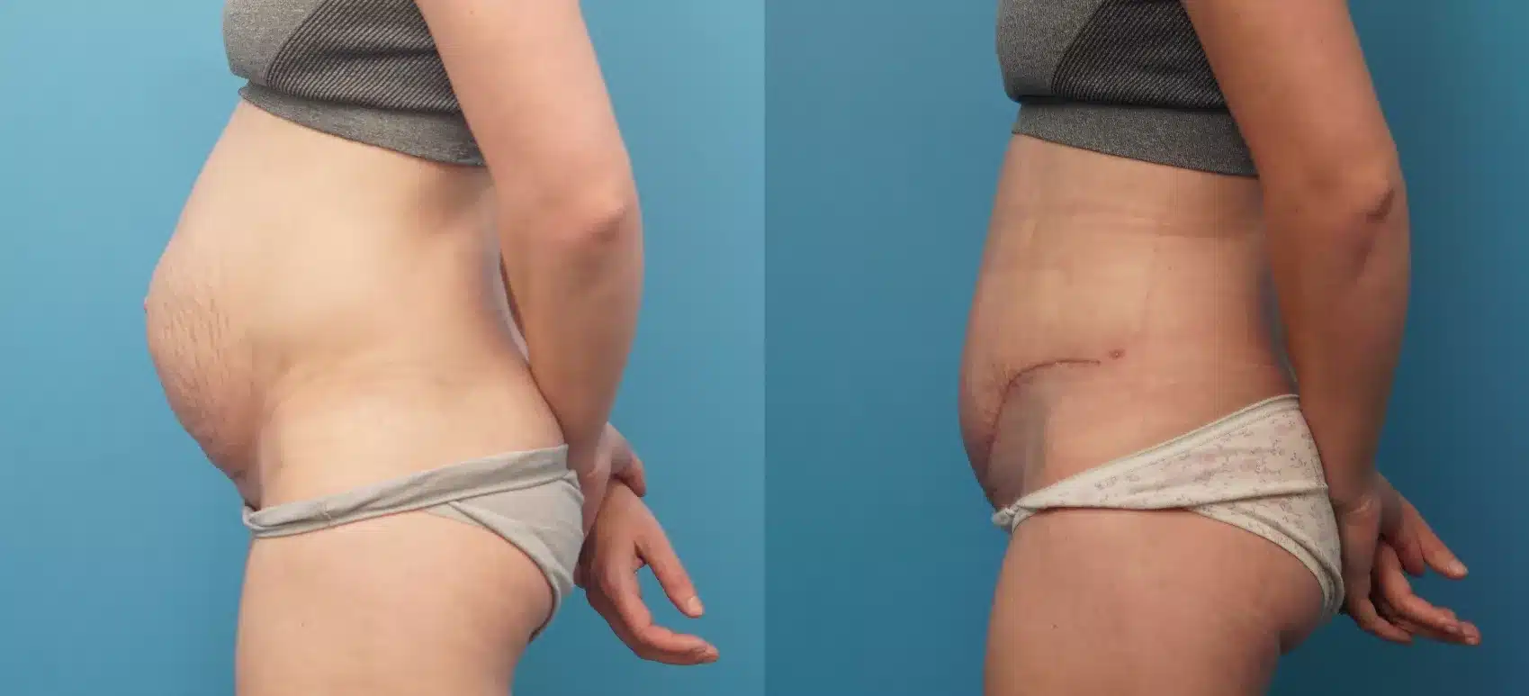 Before and After Image: Case #319 - left-side