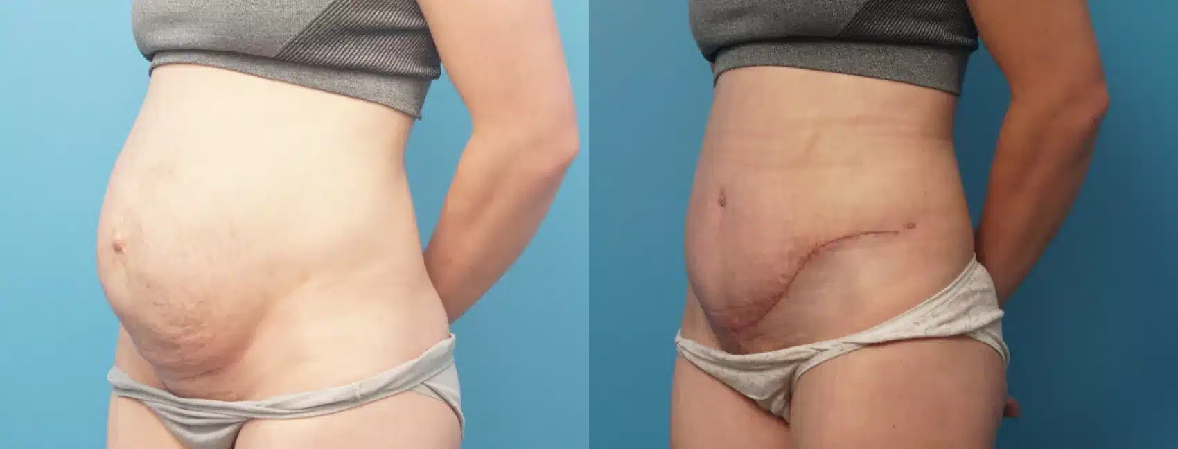 Before and After Image: Case #319 - left-front-oblique