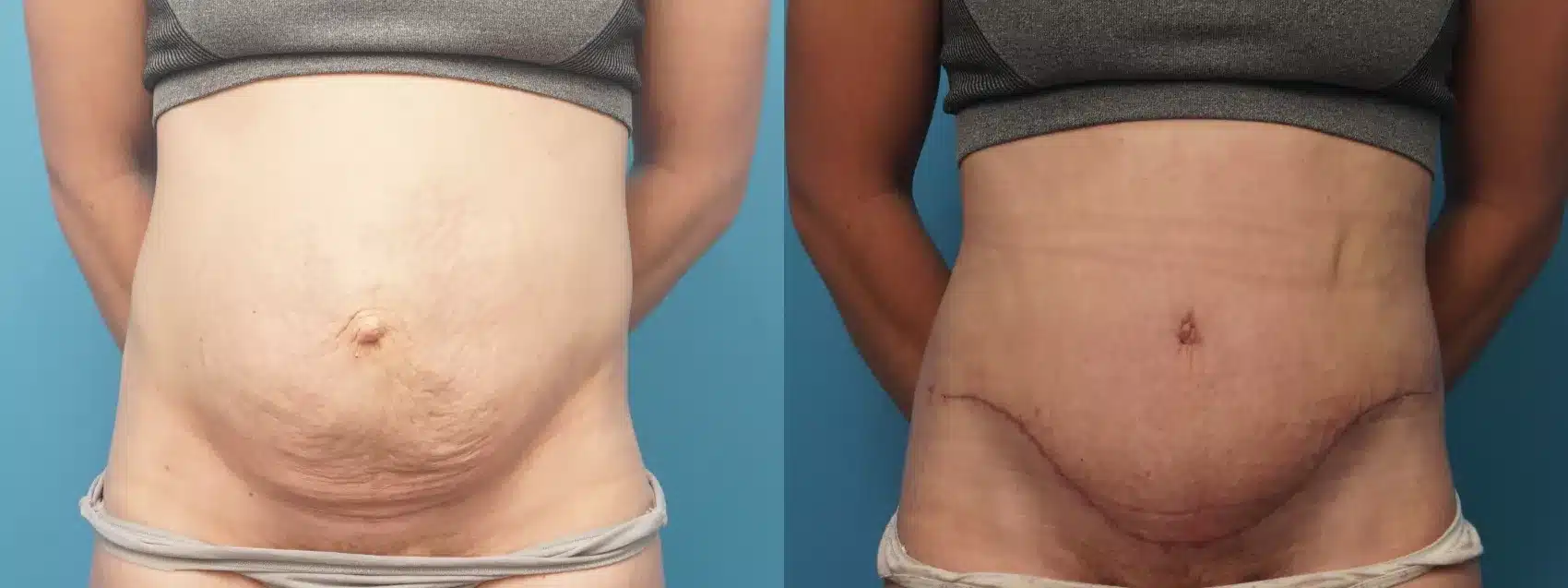Before and After Image: Case #319 - front
