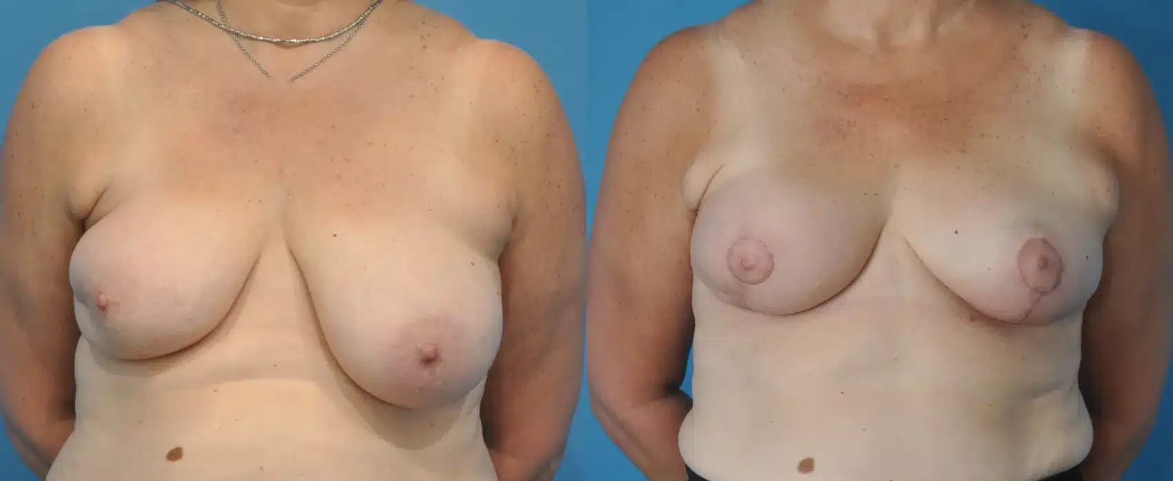 Before and After Image: Oncoplastic Reduction and Lift for Breast Cancer - front