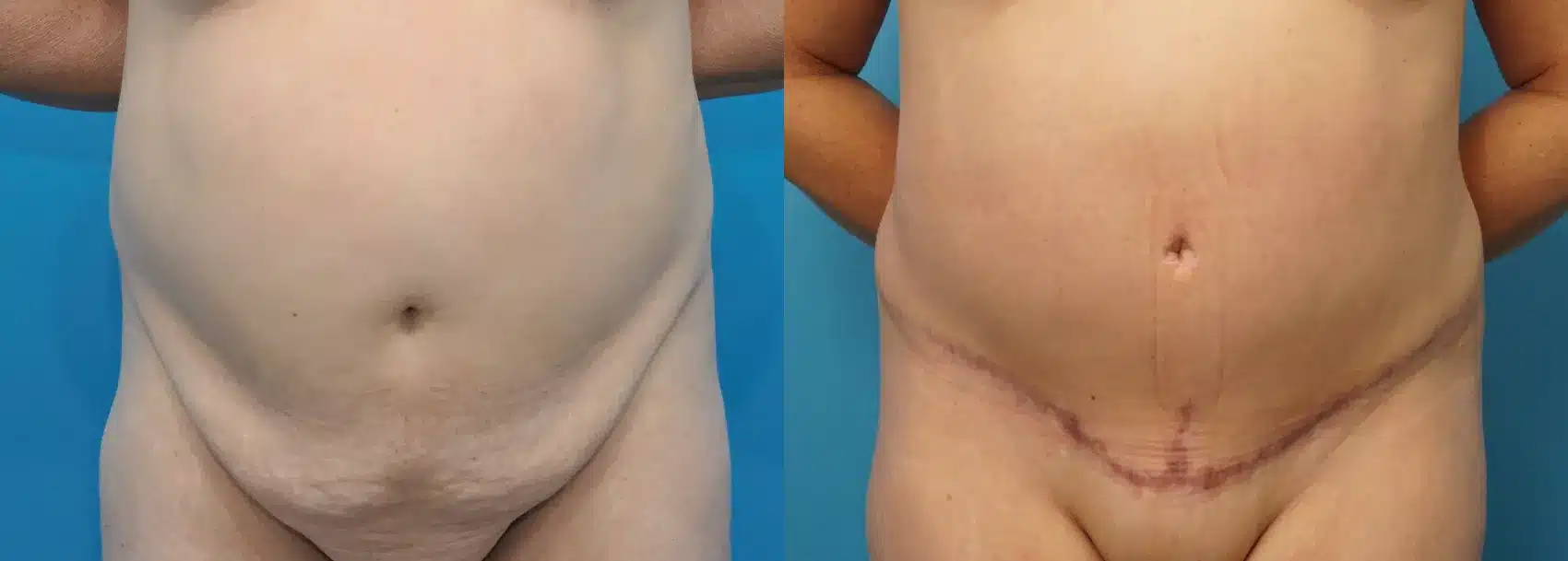 Before and After Image: Abdominoplasty - front