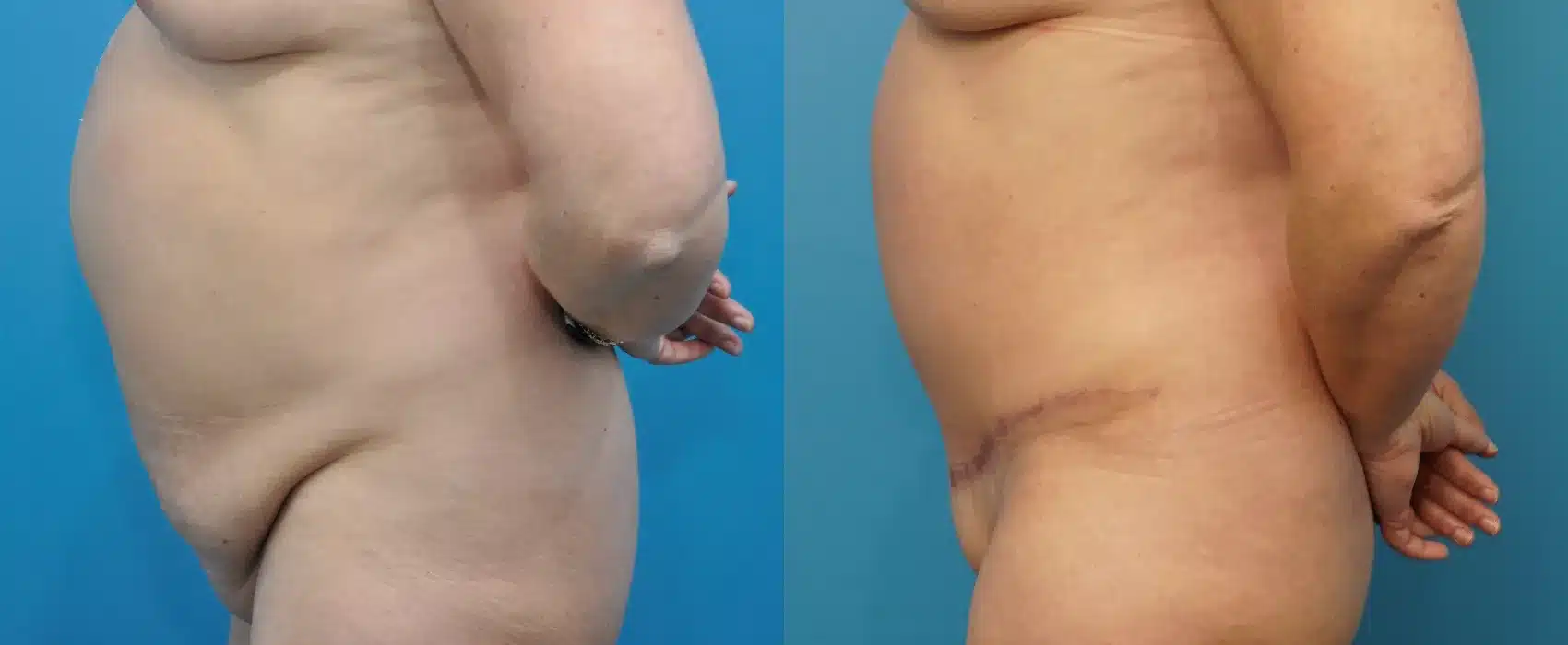 Before and After Image: Abdominoplasty - left-side