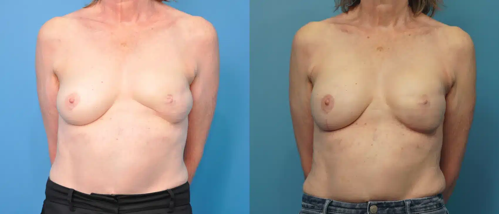 Before and After Image: Revision Breast Reconstruction - front