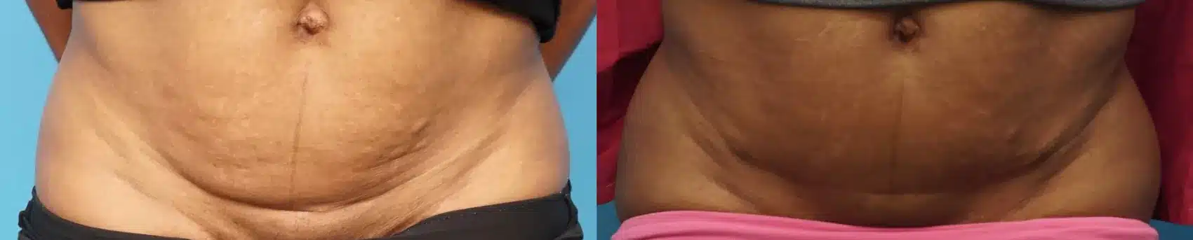 Before and After Image: Case #327 - front