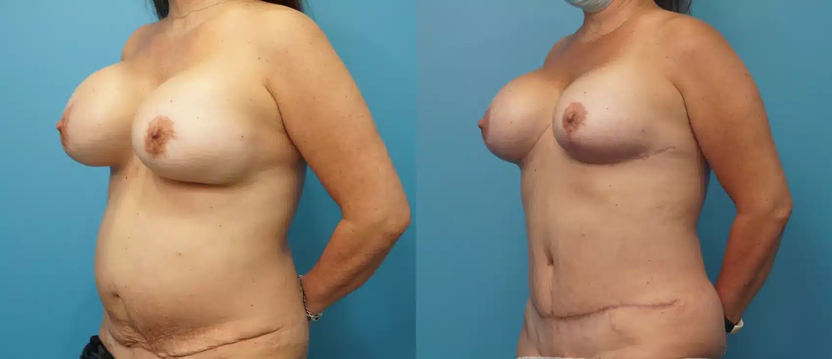 Before and After Image: Case #328 - left-front-oblique