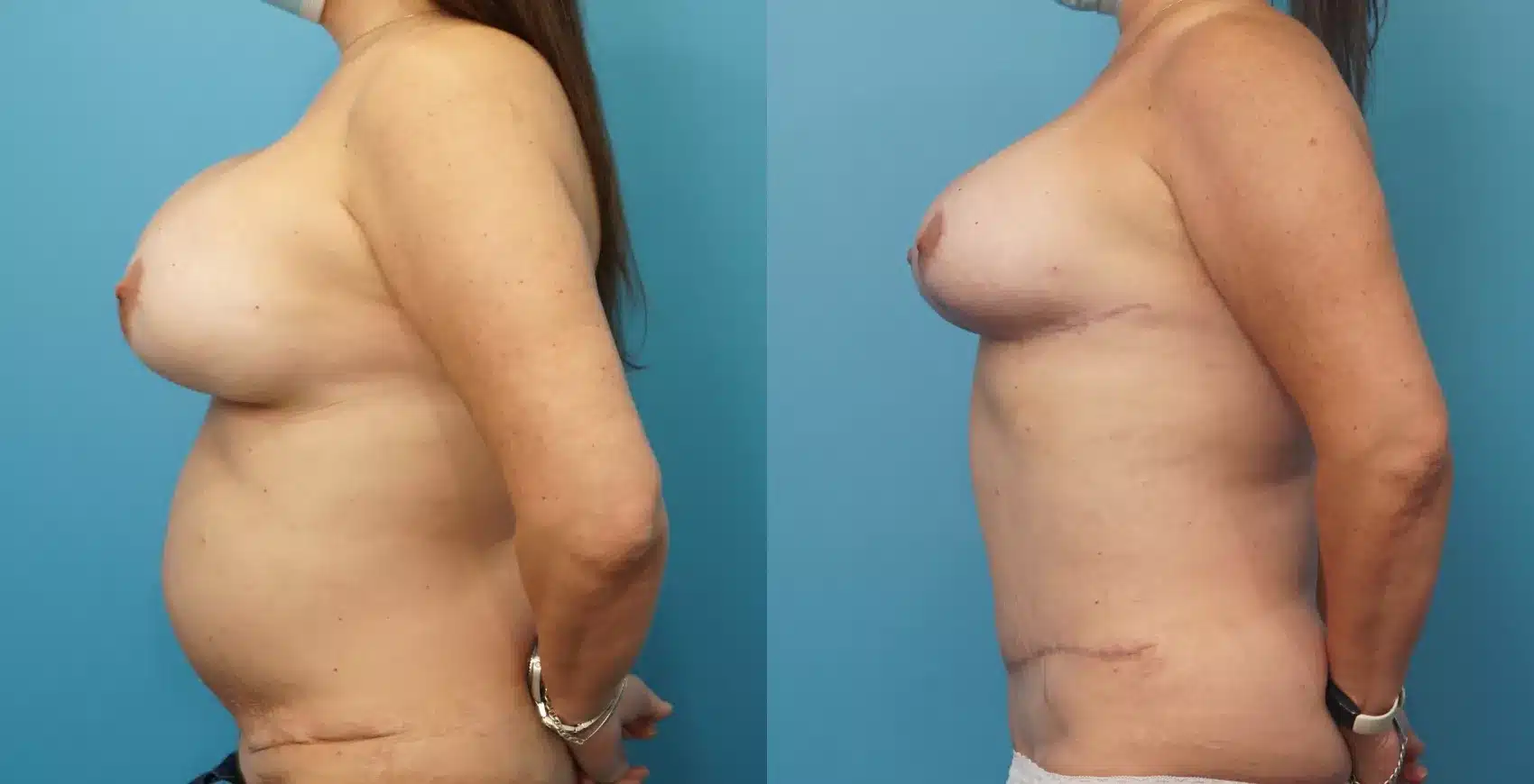 Before and After Image: Case #328 - left-side