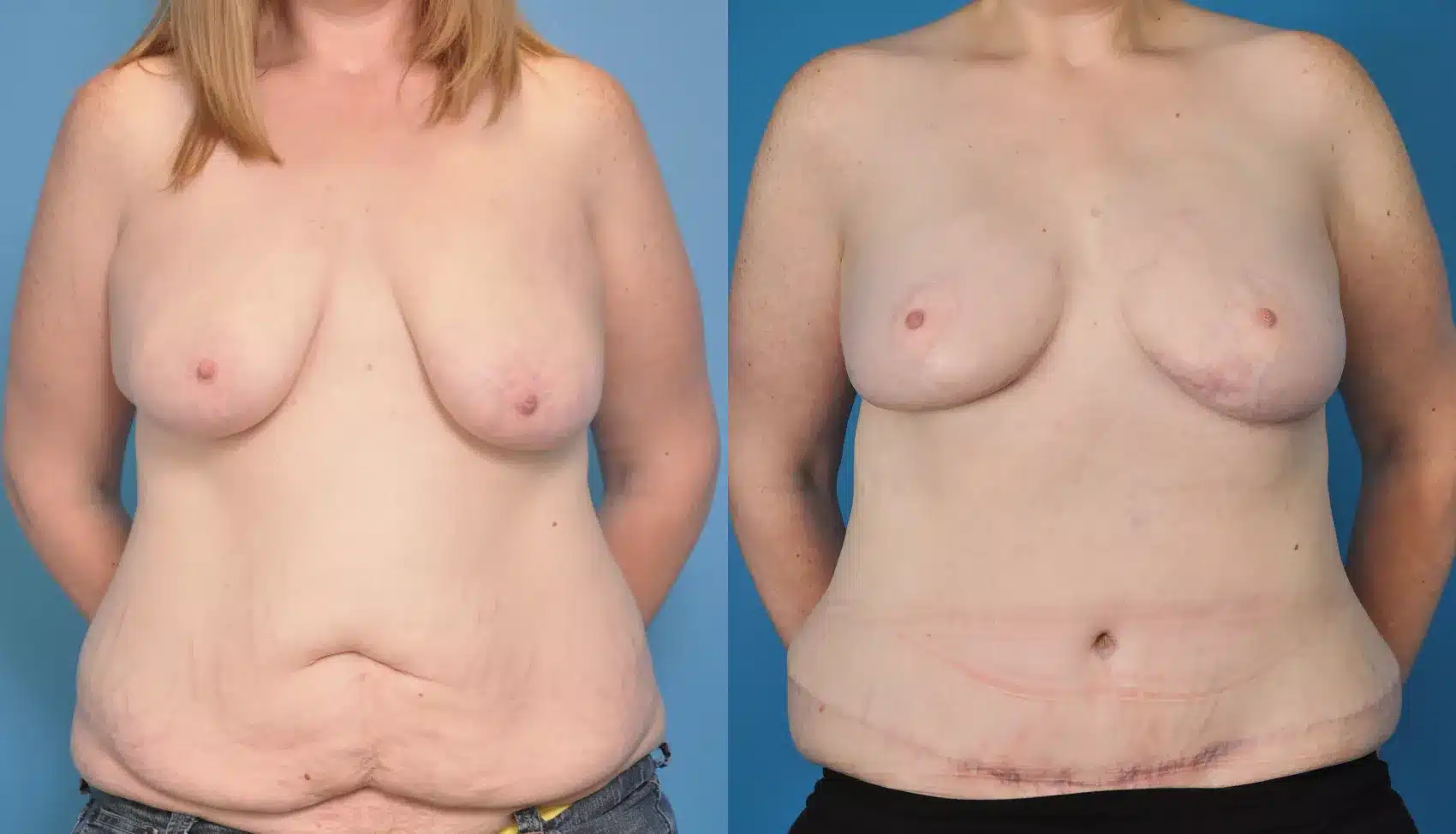 Before and After Image: Case #33 - front