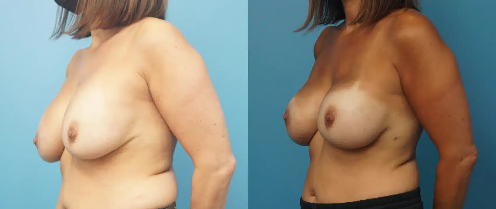 Before and After Image: Direct to Implant Mastectomy Reconstruction - left-front-oblique