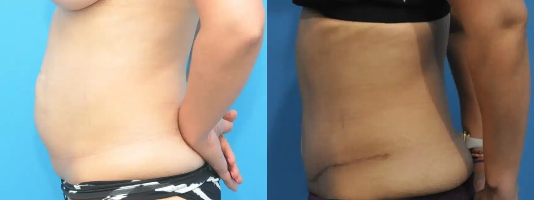Before and After Image: Case #331 - left-side