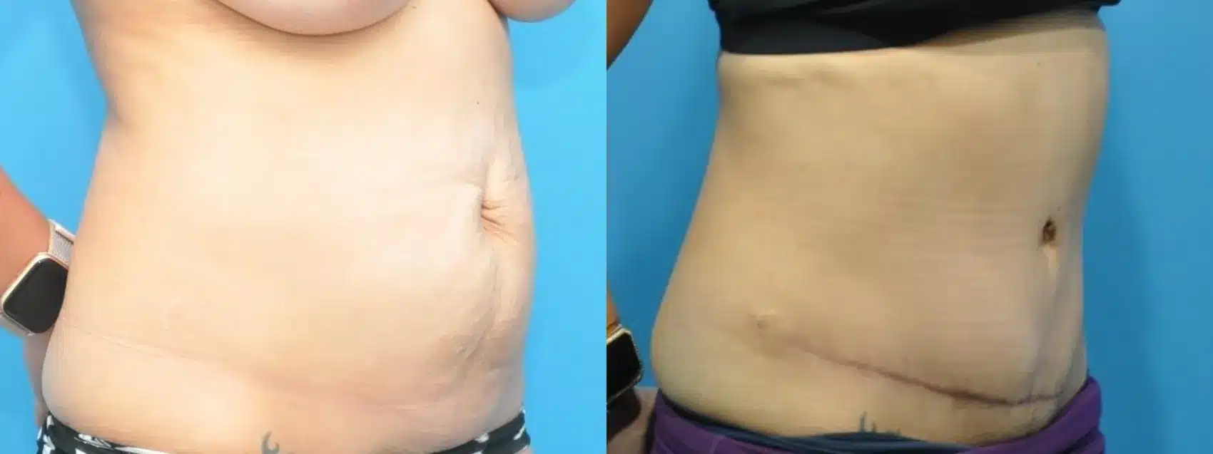 Before and After Image: Case #331 - right-front-oblique