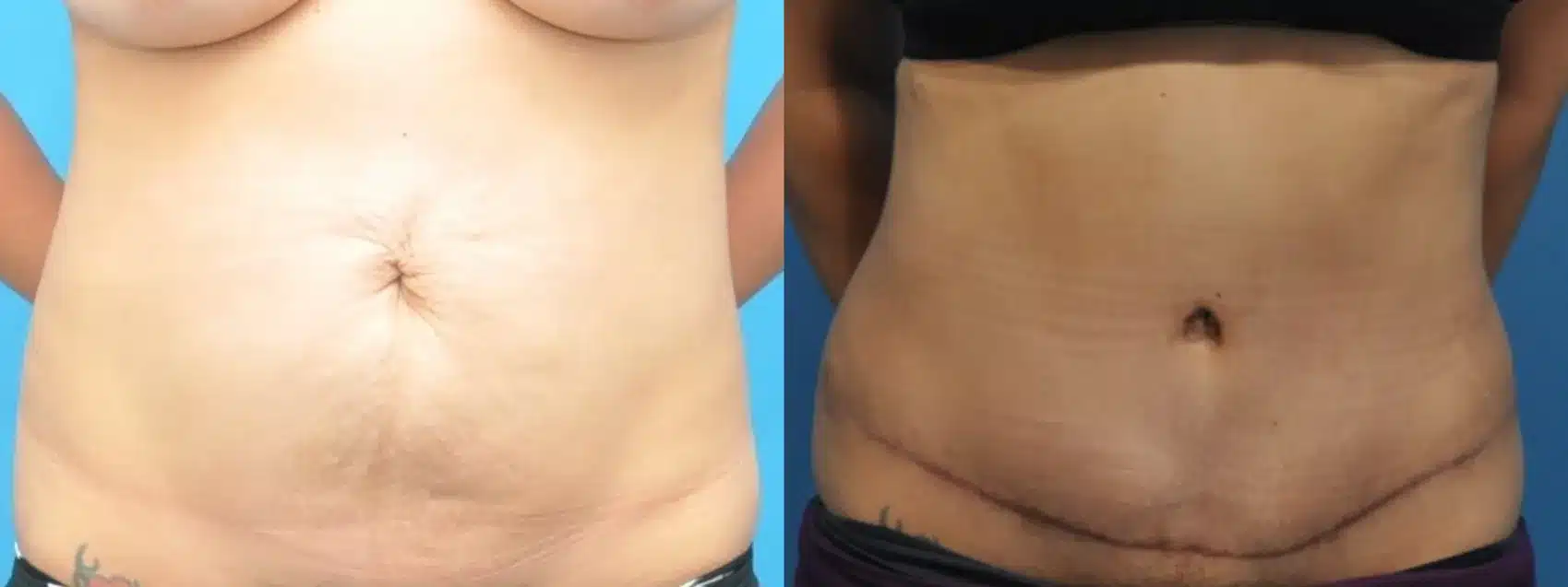 Before and After Image: Case #331 - front