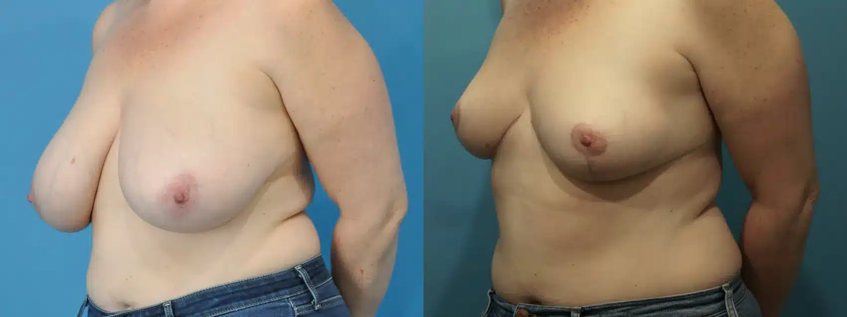 Before and After Image: Breast Reduction and Lift - left-front-oblique