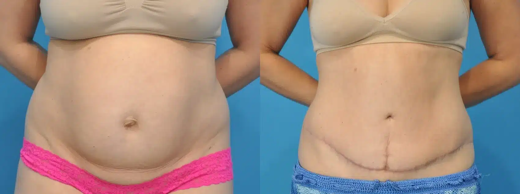 Before and After Image: Tummy Tuck - front