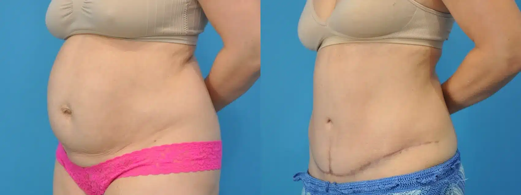 Before and After Image: Tummy Tuck - left-front-oblique