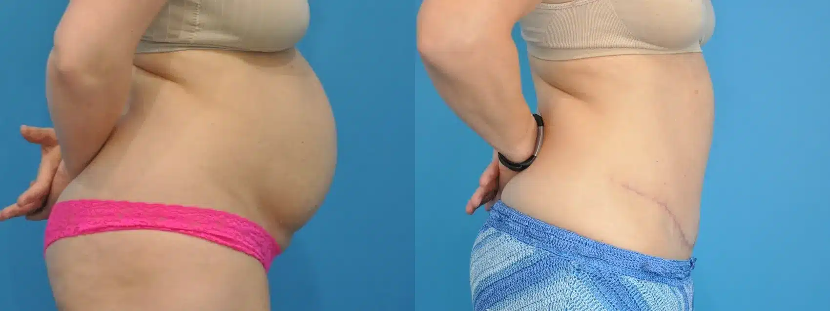 Before and After Image: Tummy Tuck - right-side