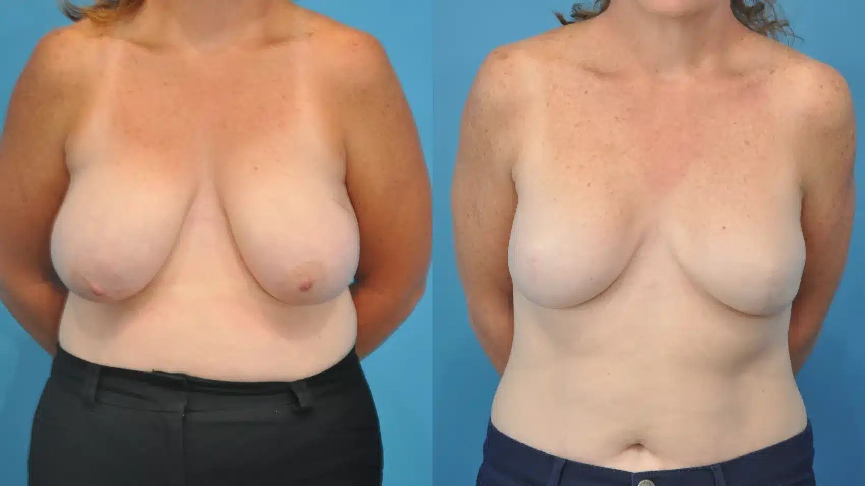 Before and After Image: Mastectomy Reconstruction with Implants - front