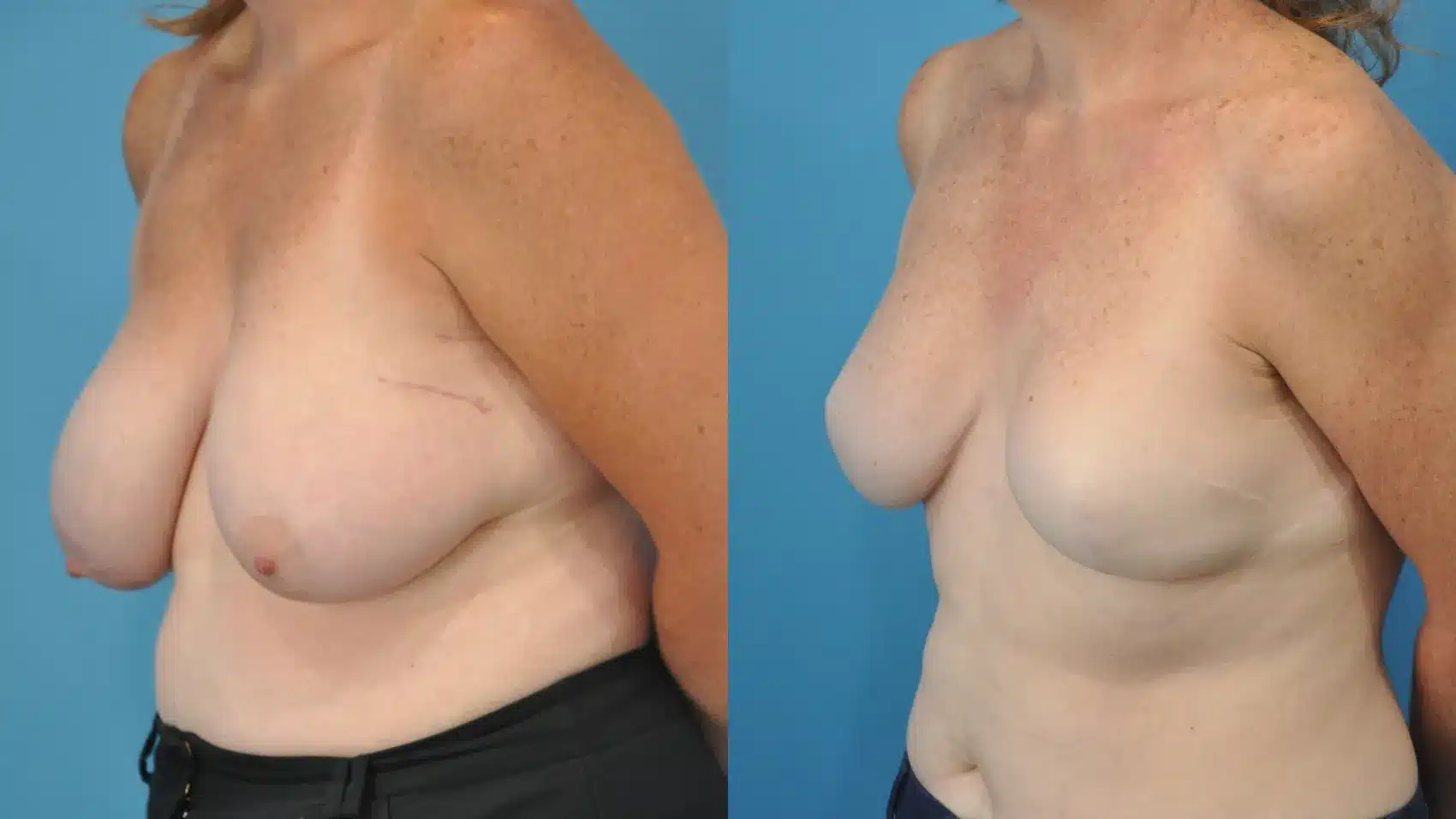Before and After Image: Mastectomy Reconstruction with Implants - left-front-oblique