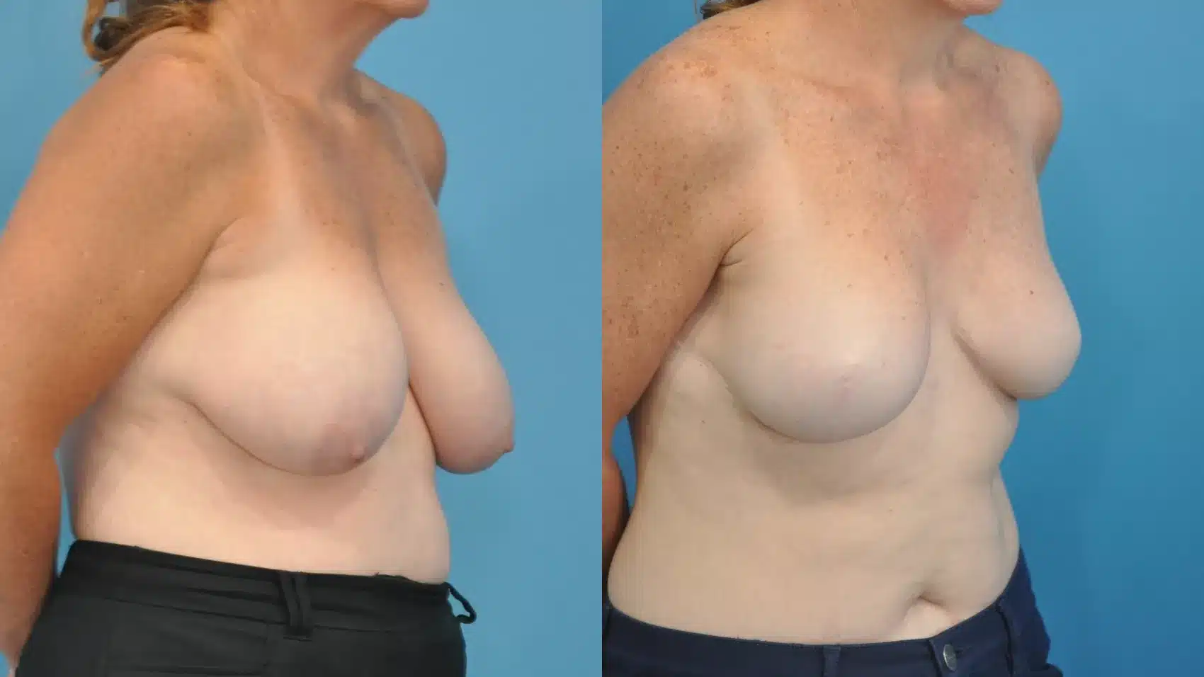 Before and After Image: Mastectomy Reconstruction with Implants - right-front-oblique