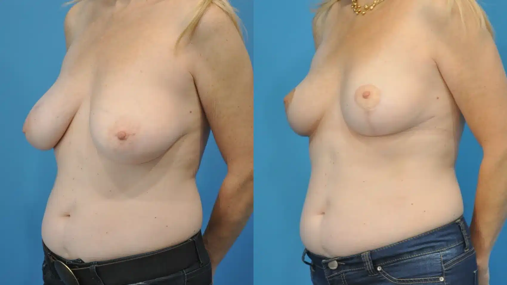 Before and After Image: Breast Reduction and Lift - left-front-oblique