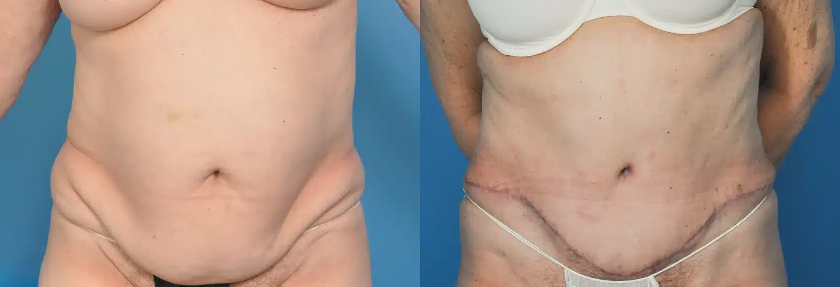 Before and After Image: Tummy Tuck - front
