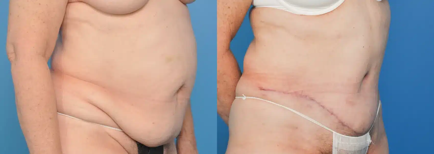 Before and After Image: Tummy Tuck - right-front-oblique