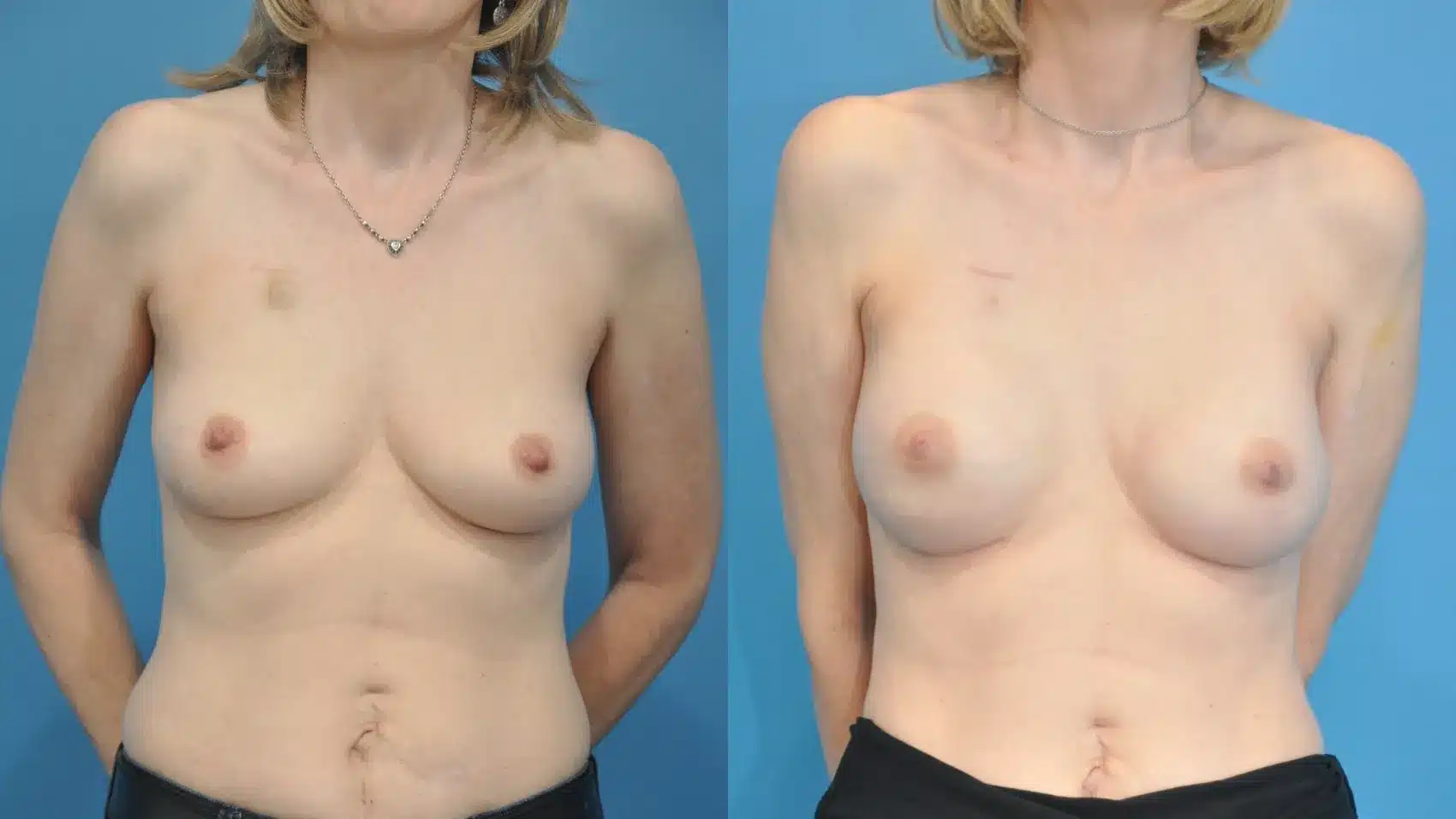 Before and After Image: Breast Reconstruction with Implants - front