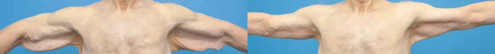 Before and After Image: Male Brachioplasty after Weight Loss - front