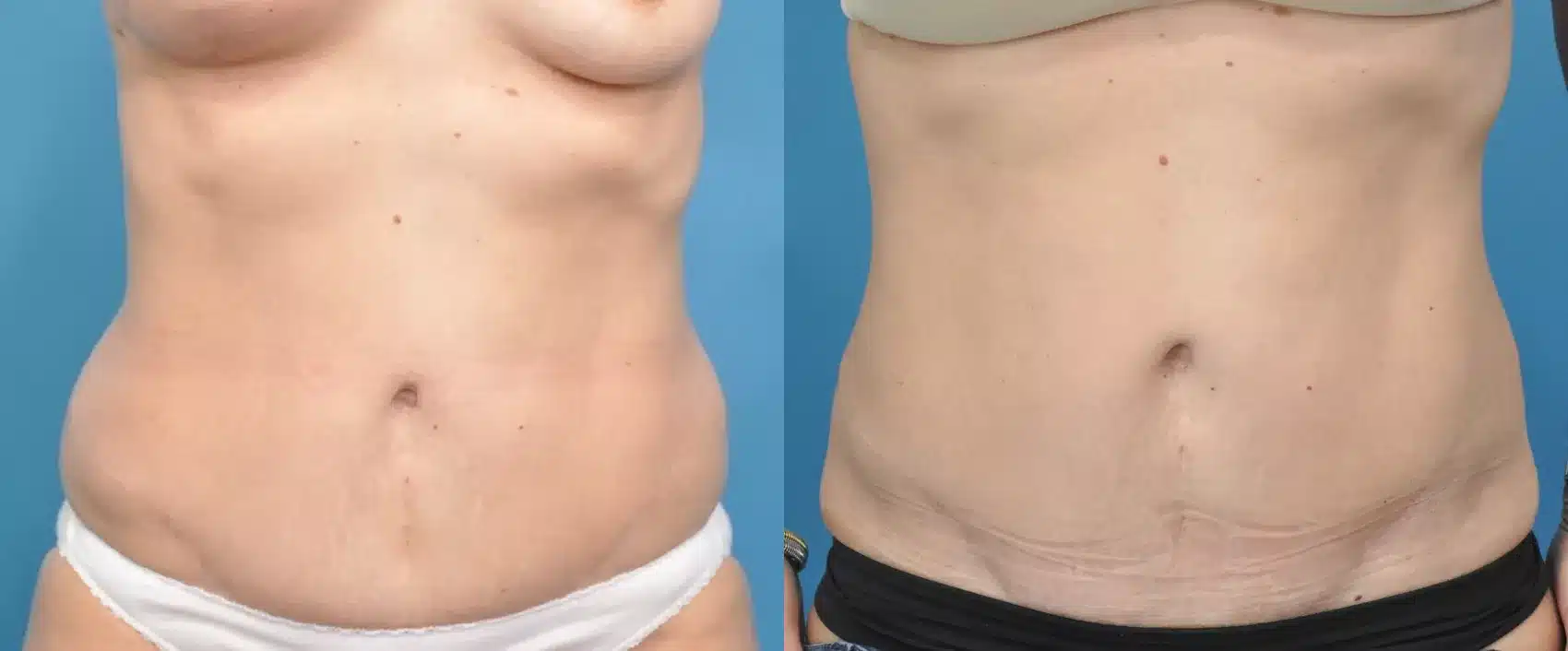 Before and After Image: Case #343 - front