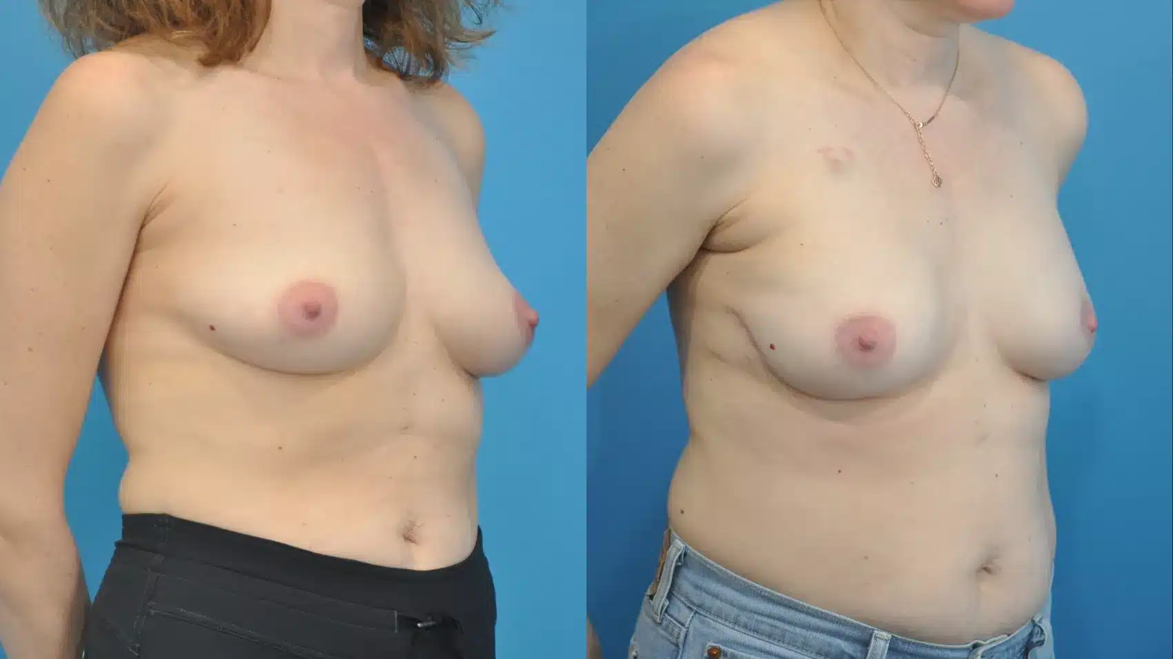 Before and After Image: Case #344 - right-front-oblique