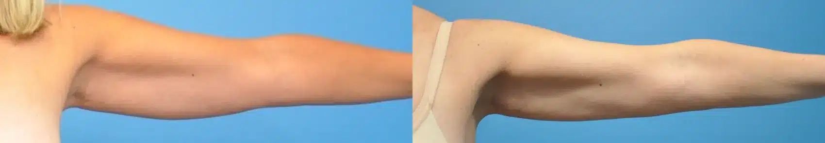 Before and After Image: Arm Liposuction - front