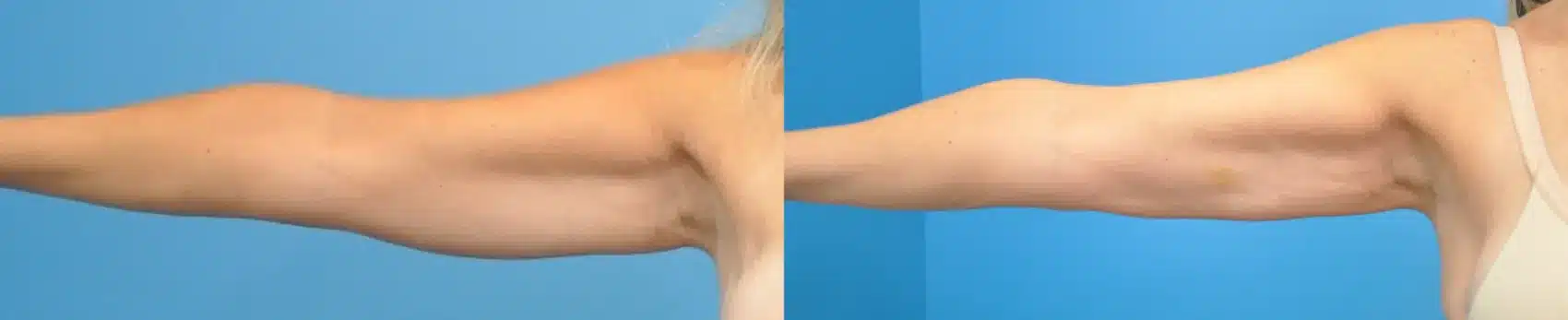 Before and After Image: Arm Liposuction - front