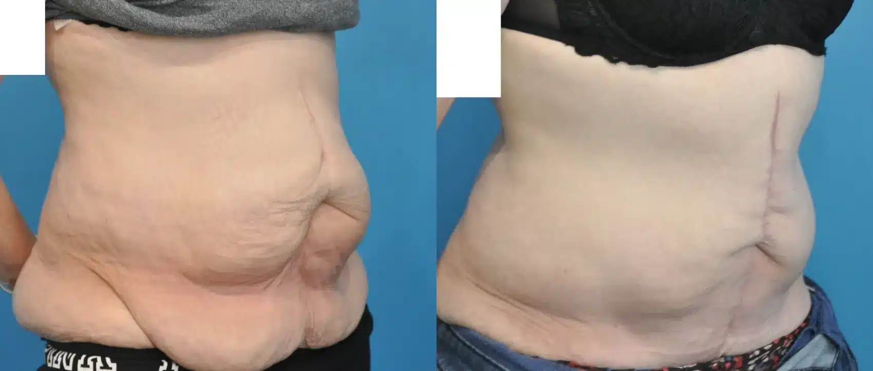 Before and After Image: Case #347 - right-front-oblique